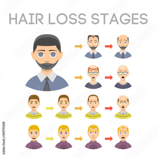 Information chart of hair loss stages types of baldness illustrated on male head vector.