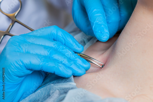 Operation to install microdermal piercing