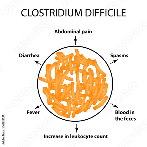 Clostridium difficile. Pathogenic flora. The bacterium causes intestinal diseases. Symptoms of infection. Infographics. Vector illustration. photo