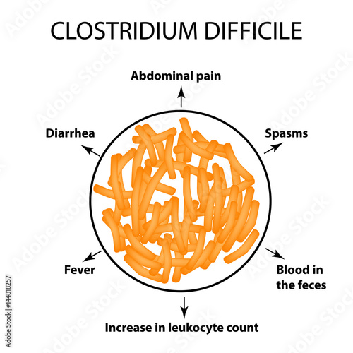 Clostridium difficile. Pathogenic flora. The bacterium causes intestinal diseases. Symptoms of infection. Infographics. Vector illustration.