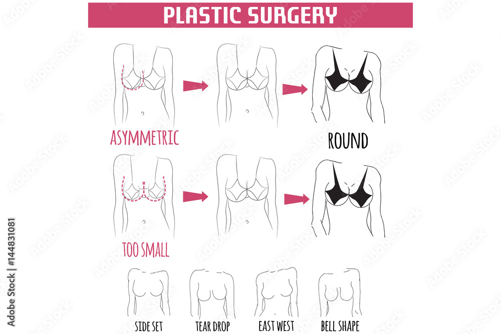 Breast plastic surgery.Vector Illustration.