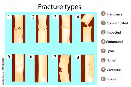 Fracture types. Vector illustration. Anatomy