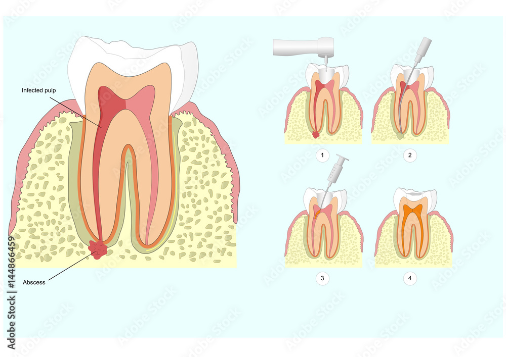 dental abscess or granuloma dental abscess or granuloma