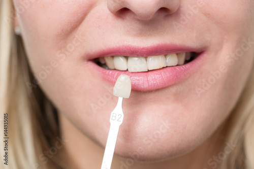 Zahnfarbe für einen Zahnersatz prüfen
