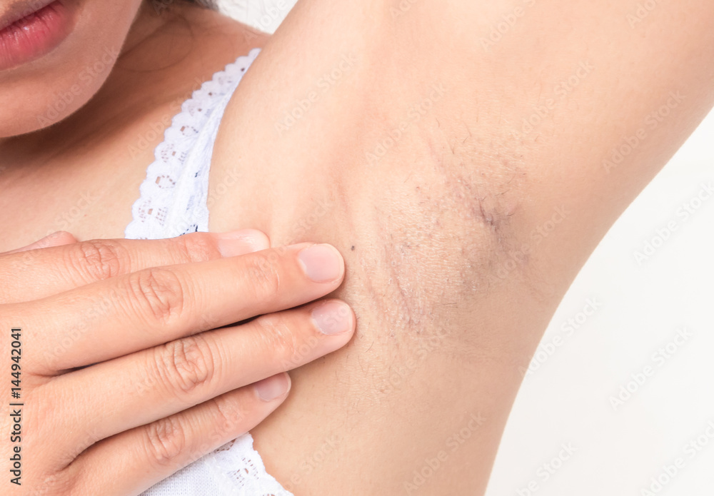 Women problem black armpit on white background for skin care and beauty concept Women problem black armpit on white background for skin care and beauty concept