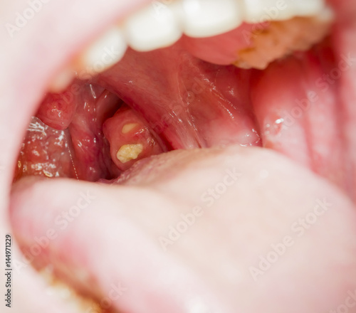 chronic tonsillitis photo