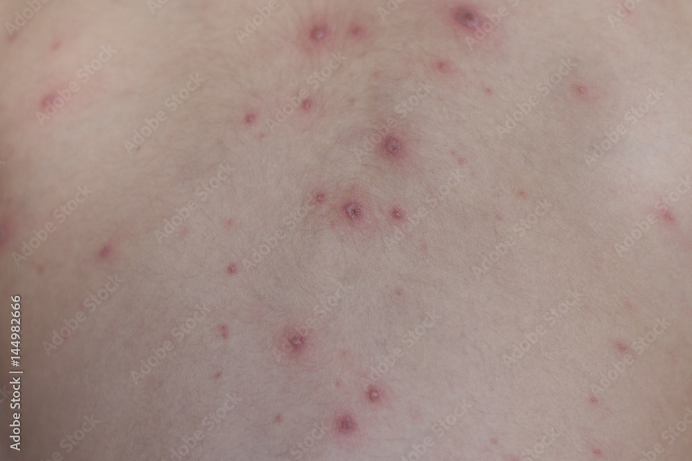 Fototapeta premium illness varicella little girl's skin