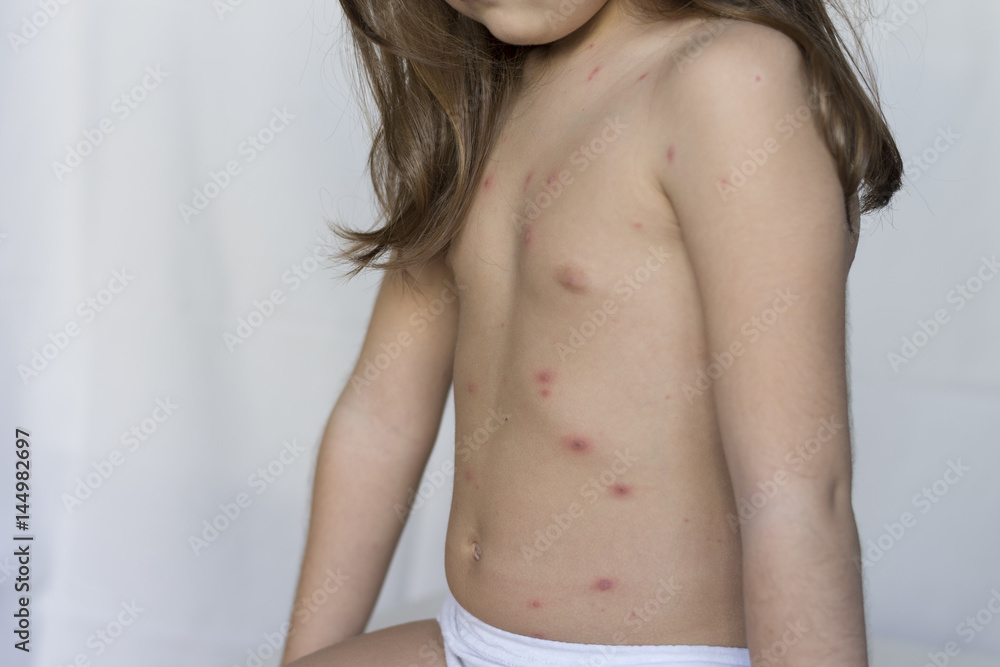 Varicella virus or Chickenpox bubble rash on child, baby or adoult Varicella virus or Chickenpox bubble rash on child, baby or adoult