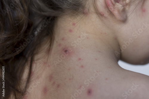 little girl with illness varicella close up