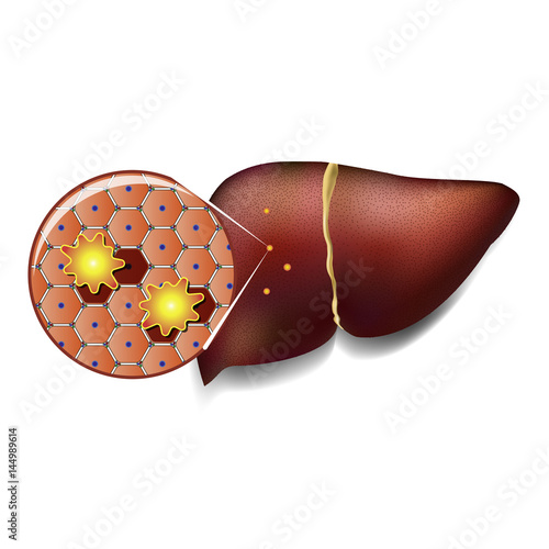 Liver Cells Attacked by Toxins