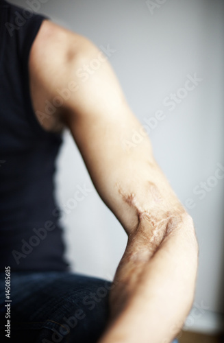 Cropped image of man with healed wound on hand