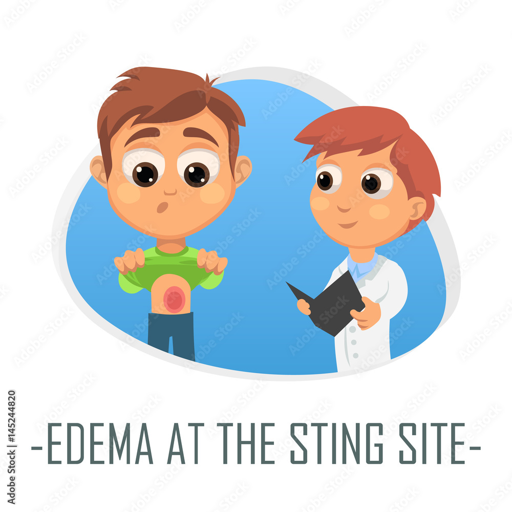 Edema at the sting site medical concept. Vector illustration. Edema at the sting site medical concept. Vector illustration.