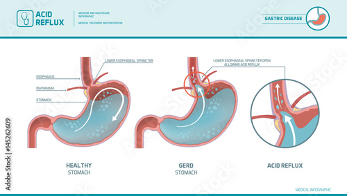 Acid reflux and heartburn infographic photo