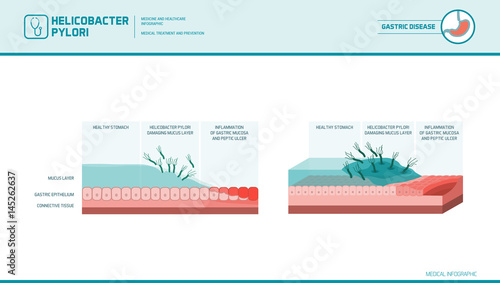 Peptic ulcer and helicobacter pylori photo