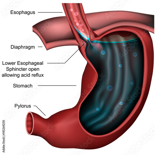 Stomach and esophagus with gastric reflux injury, vector illustration