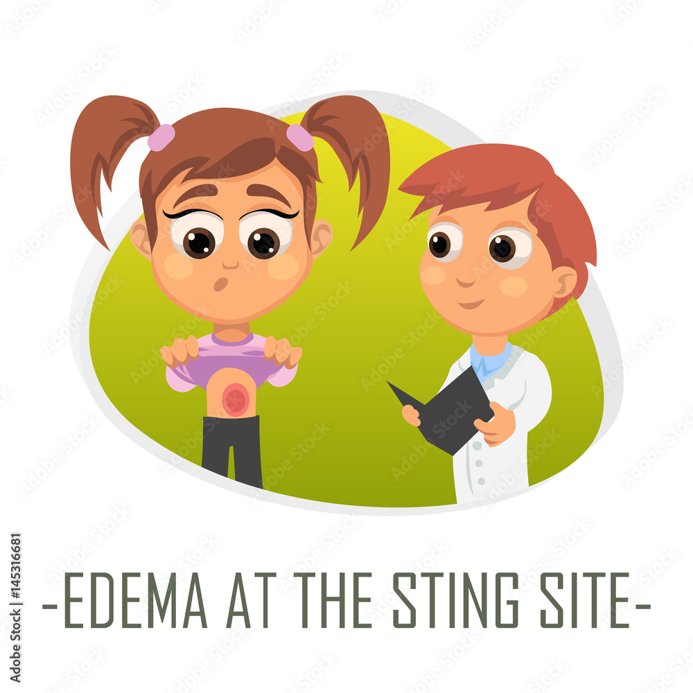 Edema at the sting site medical concept. Vector illustration. Edema at the sting site medical concept. Vector illustration.