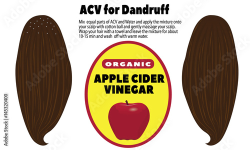 ACV for dandruff
