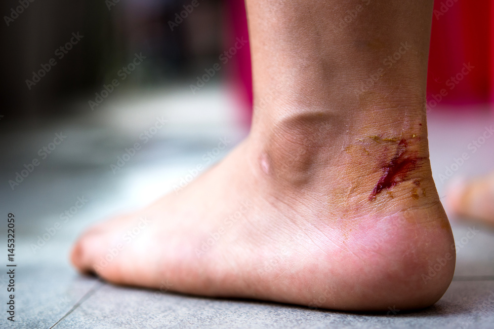 Foto de Sport injury painful knee wound accident. Close up on an