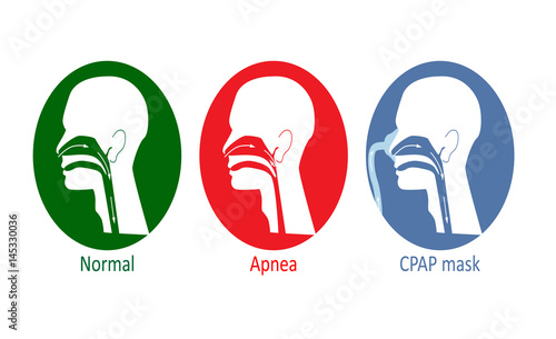Vector illustration of normal breathing, with apnea disease and with CPAP mask. 