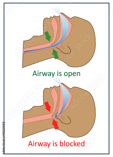 Vector illustration of normal breathing and with apnea symptoms.