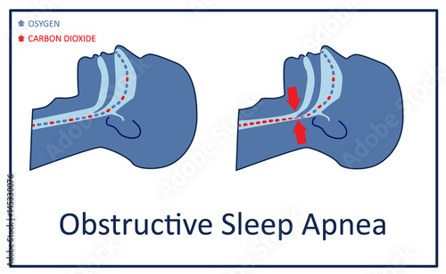 Vector illustration of obstructive sleep apnea.