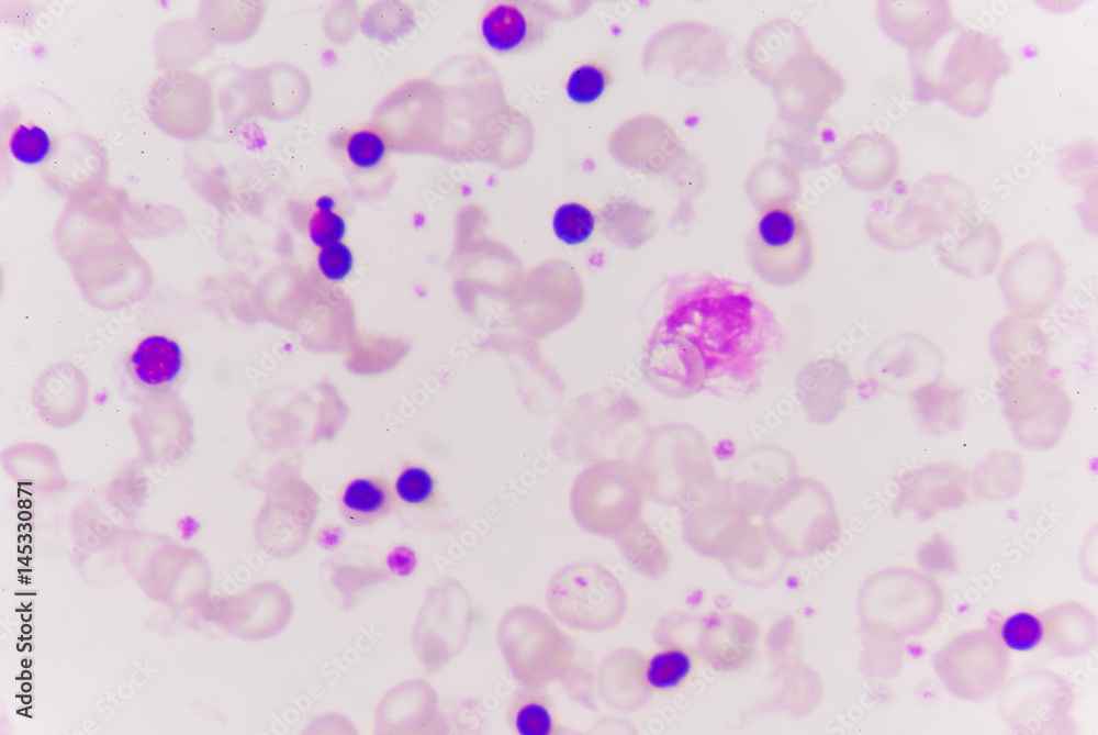 Abnormal red blood cells