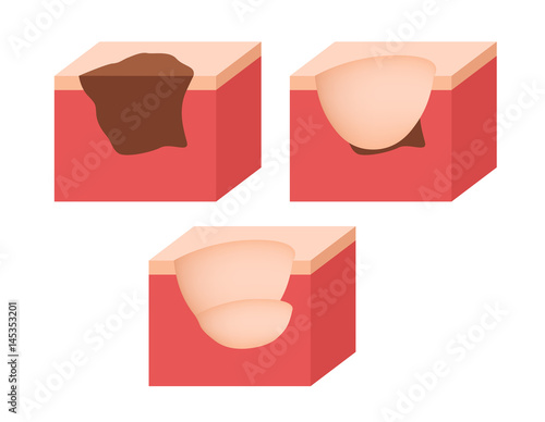 skin cancer and how to cure