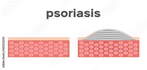 psoriasis skin vector