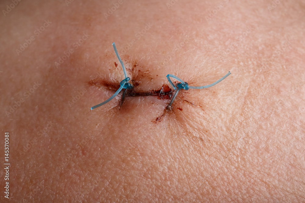 Photo of a human body on which there is a scar and a medical seam.