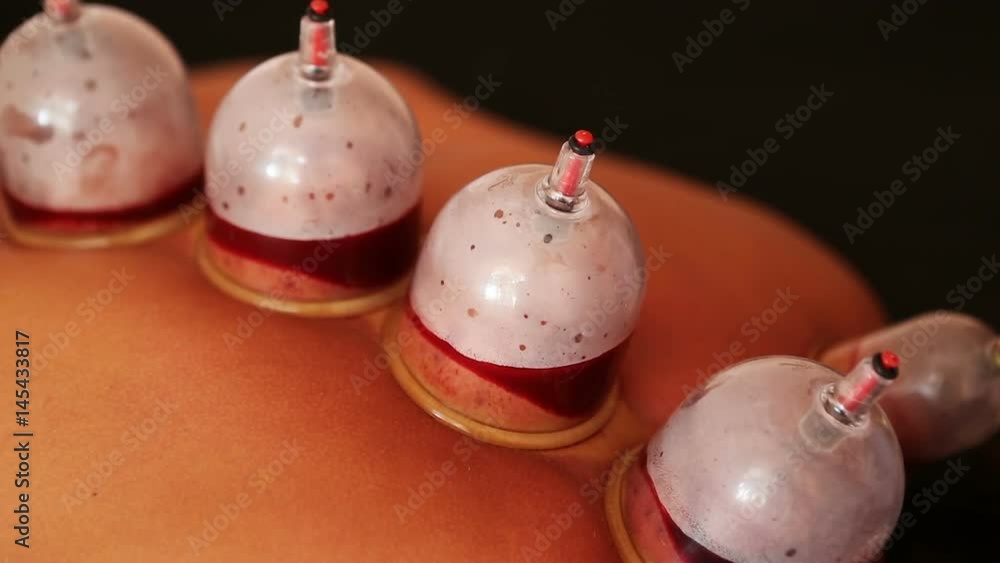 Traditional Chinese Medicine – Cupping process. Traditional Chinese Medicine – Cupping process.