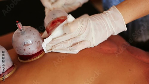 Traditional Chinese Medicine – Cupping process.