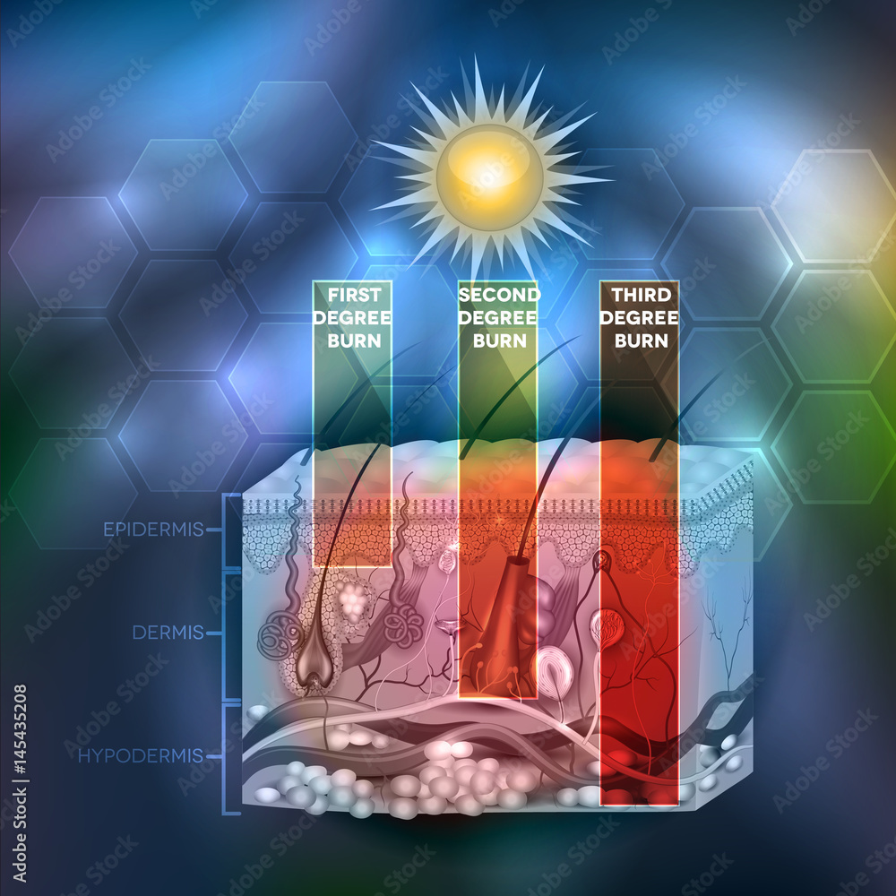 Skin burn classification. First, second and third degree skin burns. Detailed skin anatomy on an