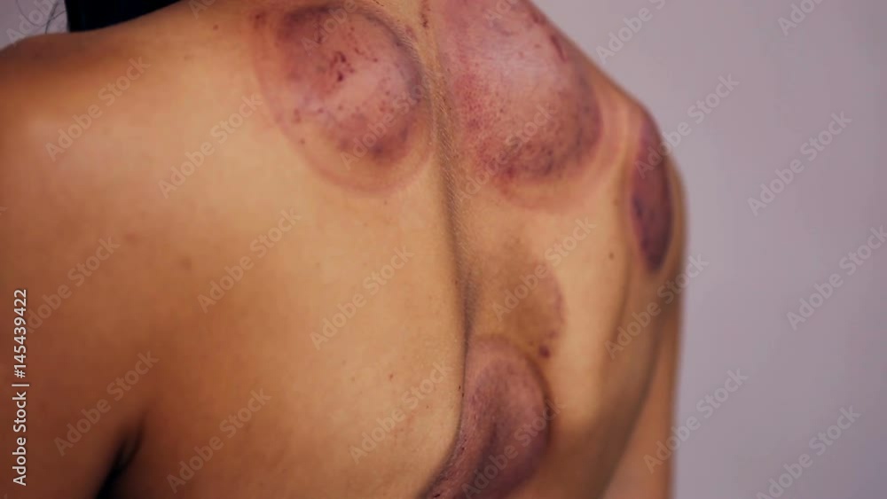 Skin After Traditional Chinese Medicine – Cupping process. Skin After Traditional Chinese Medicine – Cupping process.