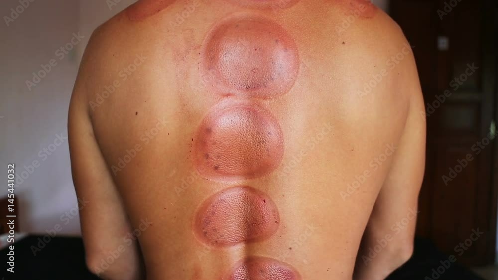 Skin After Traditional Chinese Medicine – Cupping process. Skin After Traditional Chinese Medicine – Cupping process.