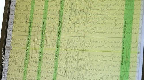 Electroencephalographic examination. Close-up shot of monitor screen with results of monitoring the functions of the human brain. HD photo