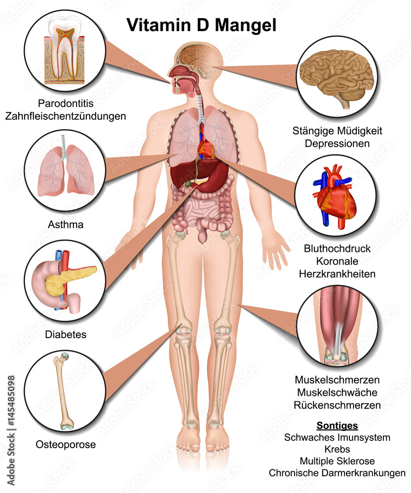 Vitamin D Mangel Anzeichen und Symptome, vektor illustration Stock Vector |  Adobe Stock