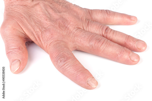 Rheumatoid polyarthritis of hands isolated on white background photo