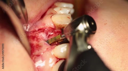 Preparation for an implant with a bone drill (jaw) for the implant of anterior tooth. A professional surgeon is working, shot with a macro shot