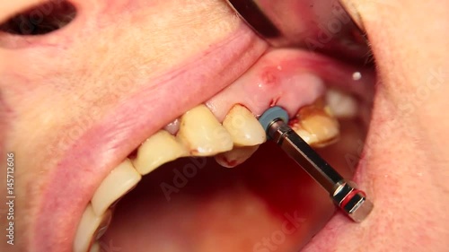 Screwing the implant of the fifth or sixth tooth of the jaw