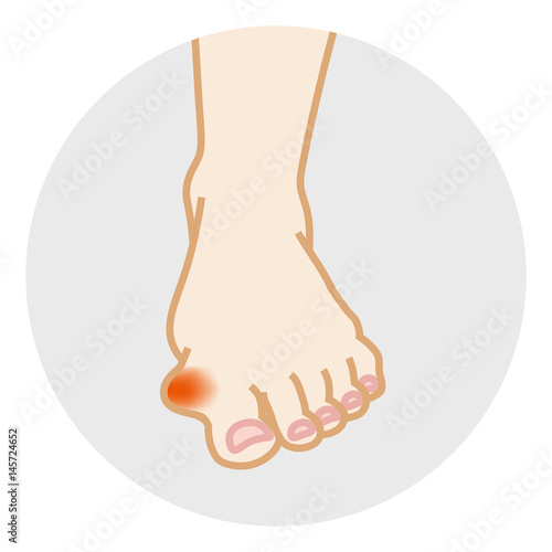 Hallux valgus - foot Trouble, Front view　
外反母趾　ボディパーツ　正面
