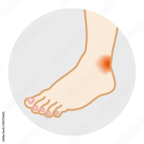 Shoe Sore -Foot  Symptom　靴擦れ　ボディパーツ