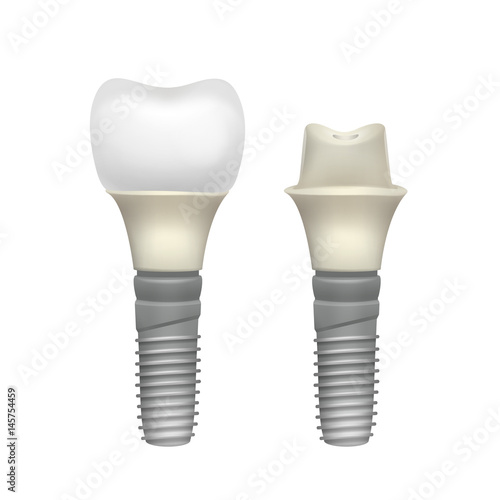 Plastic assembled tooth implant