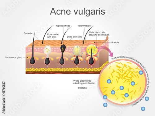 Acne Vulgaris skin. Vector graphic.
