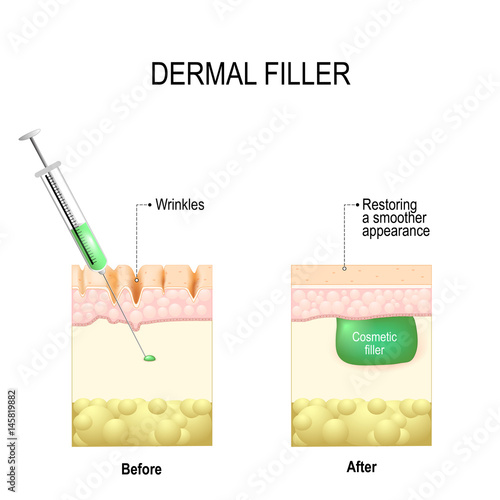 Dermal fillers