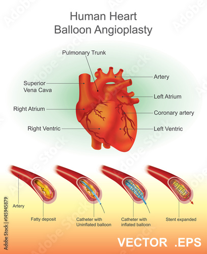 Human Heart Balloon Angioplasty. Anatomy vector Illustration.