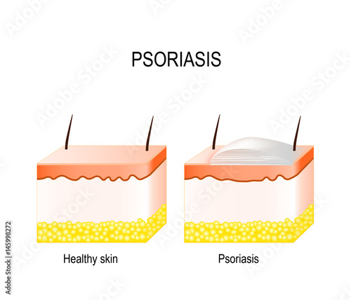 Psoriasis