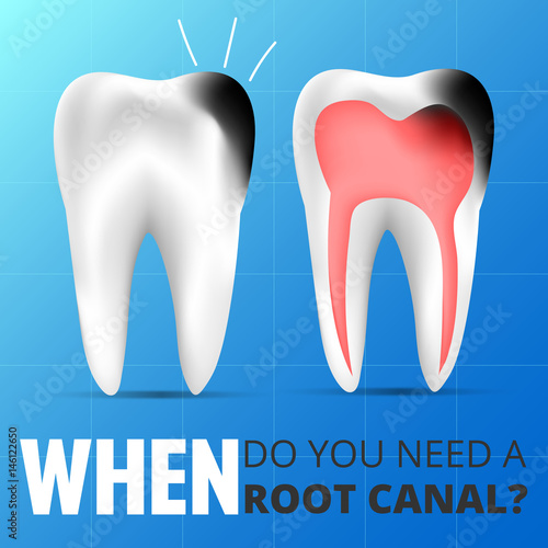 Root canal