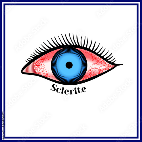 Sclerite. Inflammatory disease of sclera.