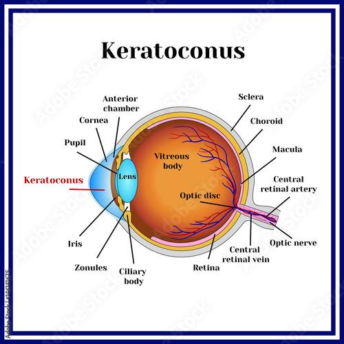 Keratoconus. Dystrophic disease of the cornea.