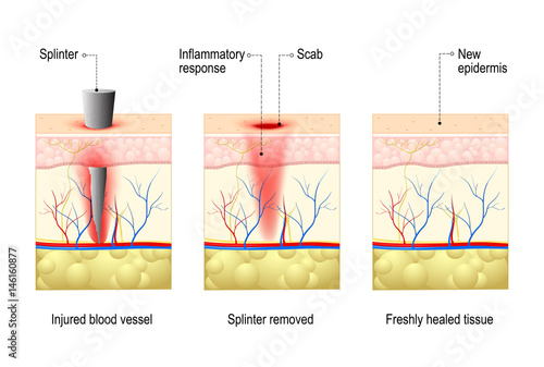 skin with splinter and wound healing.